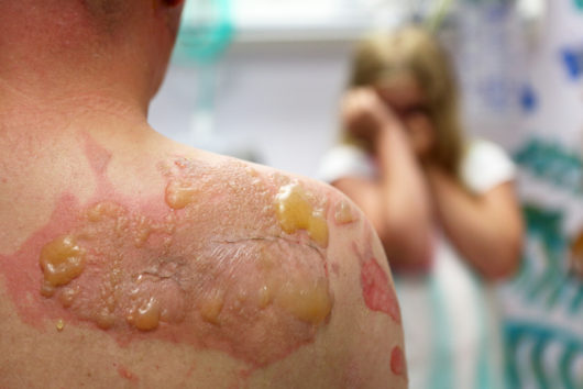 Who to Trust if You’ve Been the Victim of a Burn Accident - Law Offices
