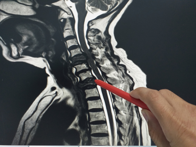 Common Outcomes of Traumatic Brain Injuries and Spinal Cord Injuries ...